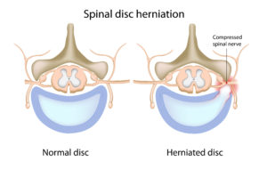 Lumbar Spine disc herniation