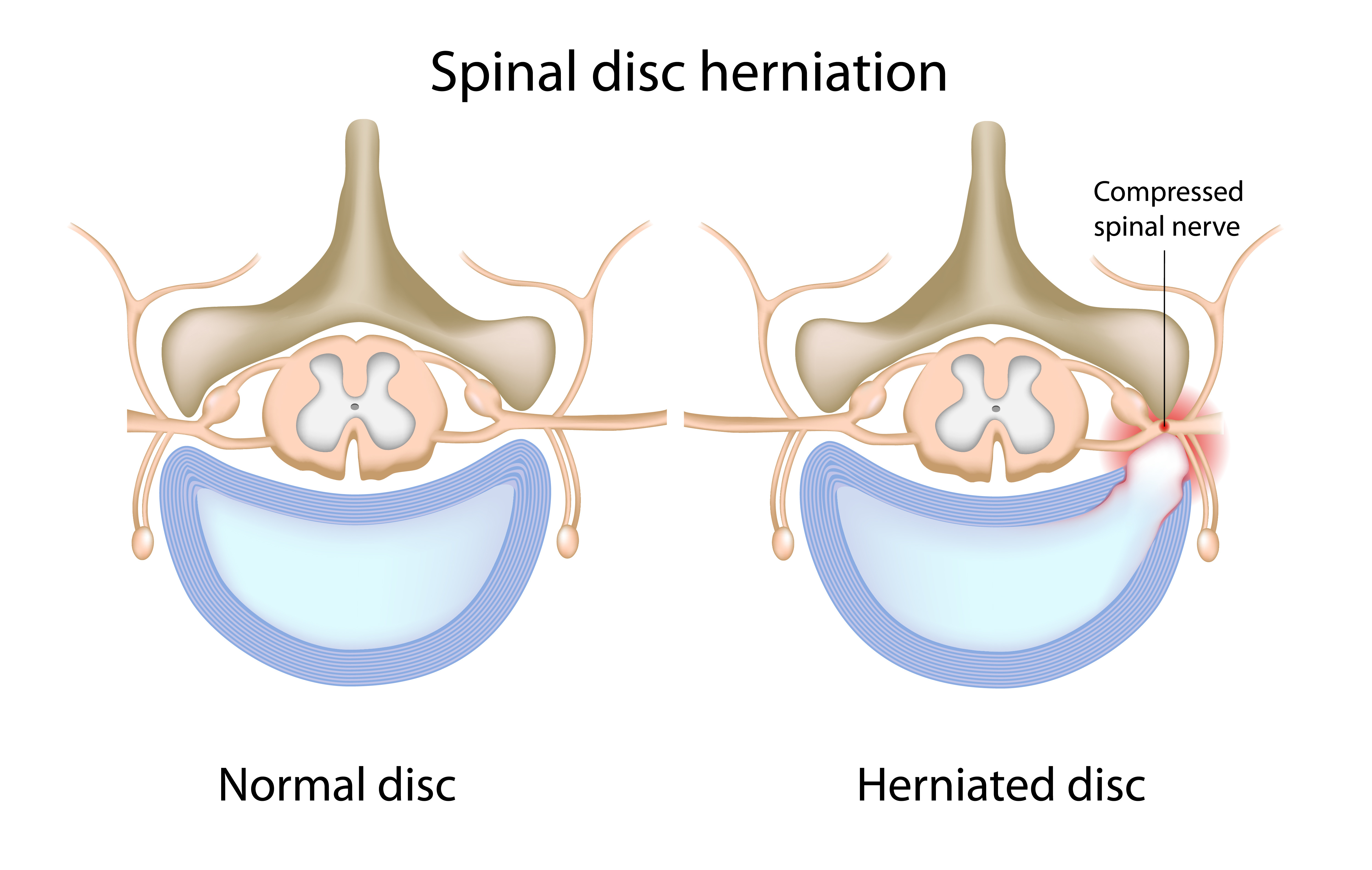 Lumbar Disc Herniation 