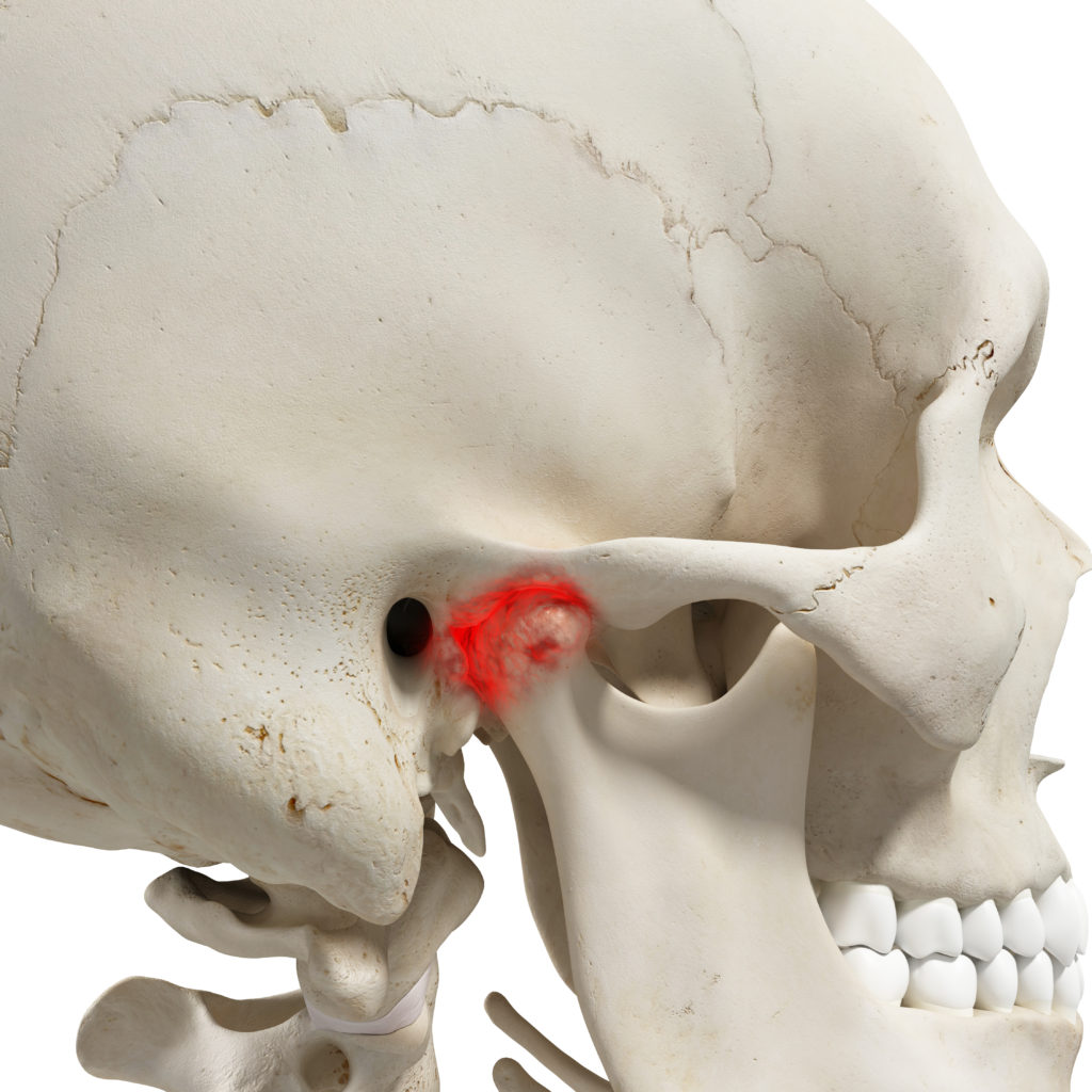 Treatment for TMJ Pain - Elite Sports and Spine Chiropractic