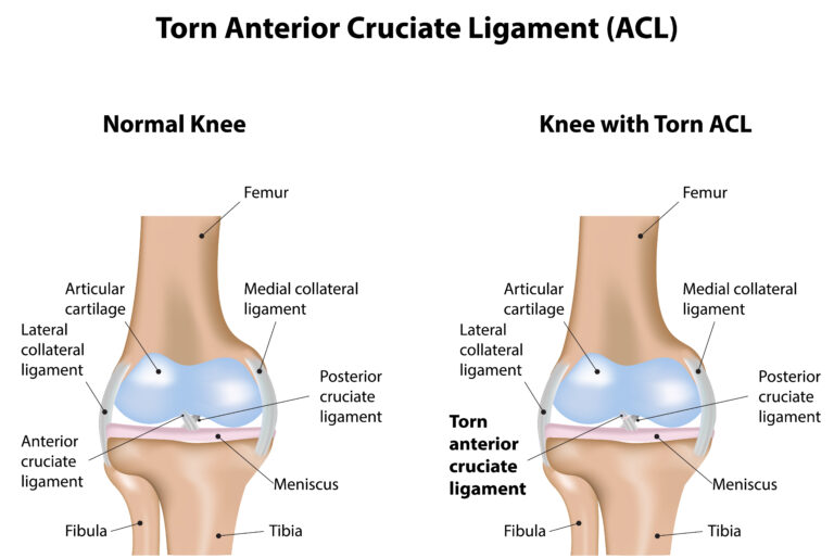 Risks for Developing ACL Injuries