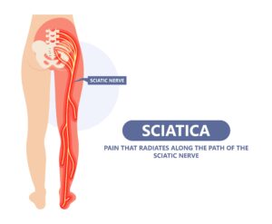 Chiropractic Treatment for Sciatica