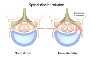 Chiropractic treatment for disc injury